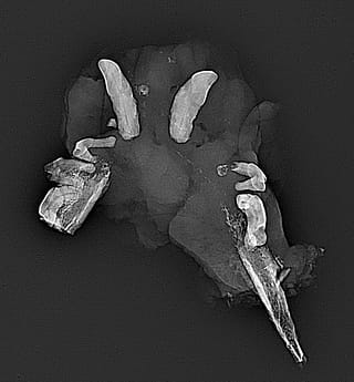 Radiografie a unei mandibulectomii mai mari de « ¾ » cu carcinom scuamos avansat