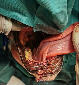 Aspect intraoperator in urma unei mandibulectomii rostrale bilaterale