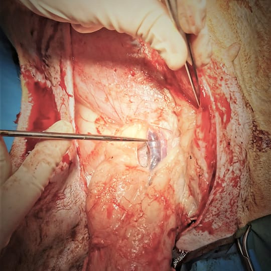 4. Aspect intraoperator al vascularizatiei mamare de la nivel inel inguinal extern